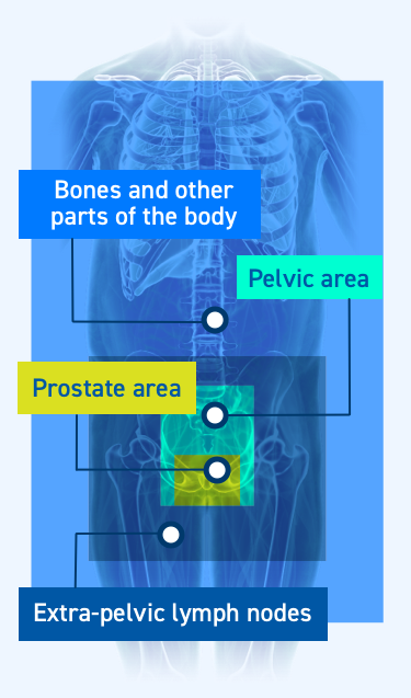 Highlighting the areas of the body where prostate cancer may spread