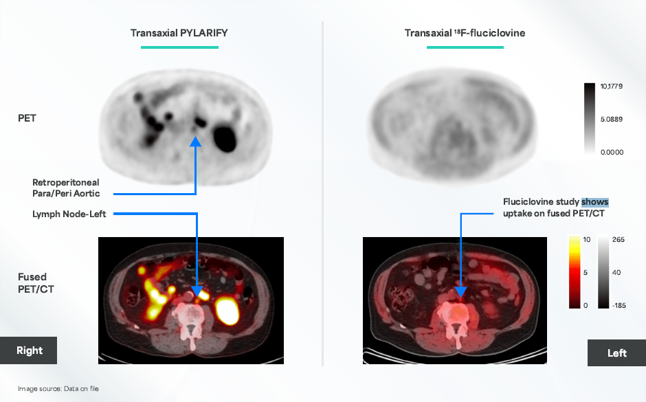PYLARIFY® PET scan revealing that a 71-year-old patient had left common iliac lesions and multiple lymph node lesions