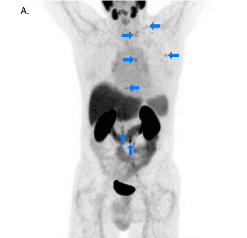 PET scan image showcasing detected lesions using 18F DCFPyL