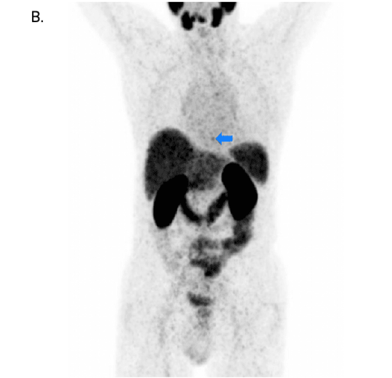 PET scan image showcasing detected lesions using 68Ga