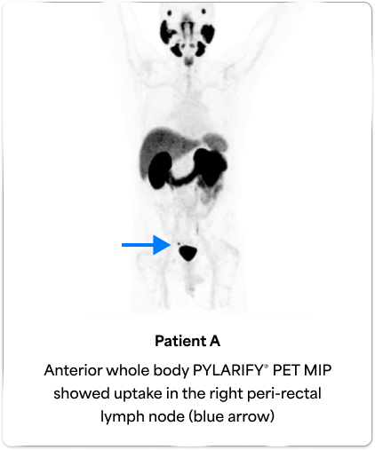 PET scan image of the male body pointing out the peri-rectal lymph node