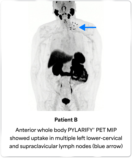 PET scan image of the male body pointing out the peri-rectal lymph node