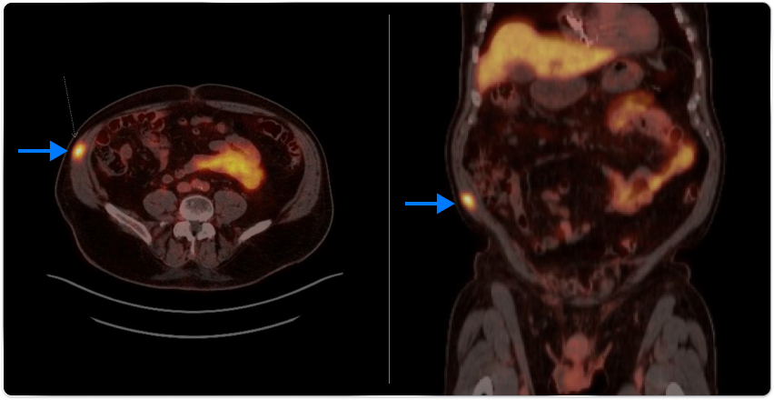 PET scan image pointing out PSMA-avid focus in the prostate/PET scan image pointing out PSMA-avid focus in the right lateral abdominal wall