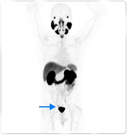 PET scan image of the male body pointing out the peri-rectal lymph node