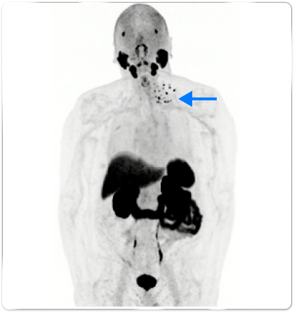 PET scan image of a male body pointing out detection in the lower-cervical and supraclavicular lymph node
