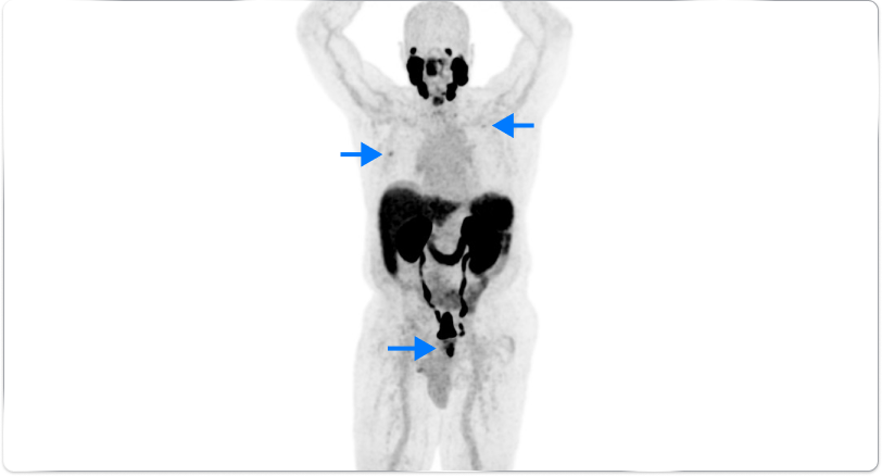 PET scan image of lungs and prostate in a male body
