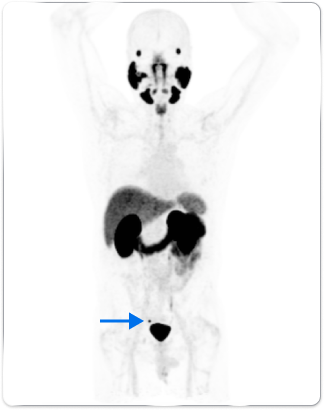 PET scan image of the male body pointing out the peri-rectal lymph node