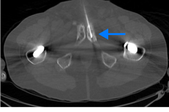 PET scan image of lungs and prostate in a male body