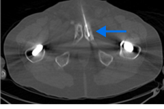 PET scan image of lungs and prostate in a male body
