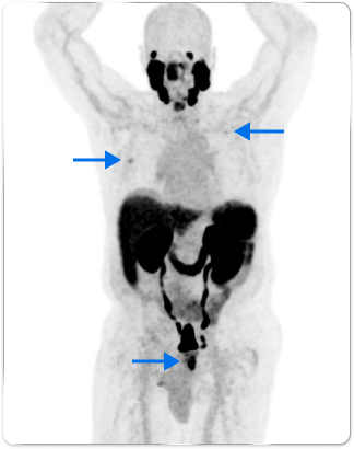 PET scan image of lungs and prostate in a male body