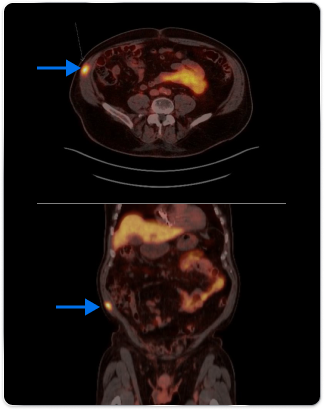 PET scan image pointing out PSMA-avid focus in the prostate/PET scan image pointing out PSMA-avid focus in the right lateral abdominal wall
