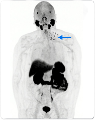 PET scan image of the male body pointing out the peri-rectal lymph node