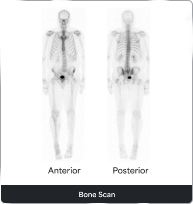 Bone scan images(anterior and posterior)