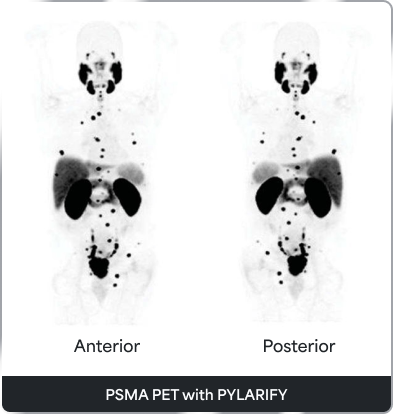 PSMA PET with PYLARIFY scan images (anterior and posterior)