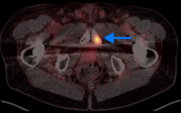 PET scan image of lungs and prostate in a male body