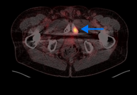 PET scan image of lungs and prostate in a male body