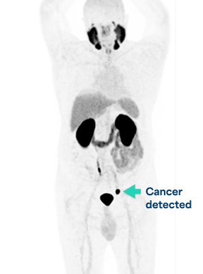 Example of a PSMA PET scan with PYLARIFY and what a doctor may see