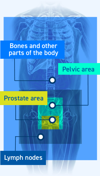 Highlighting the areas of the body where prostate cancer may spread